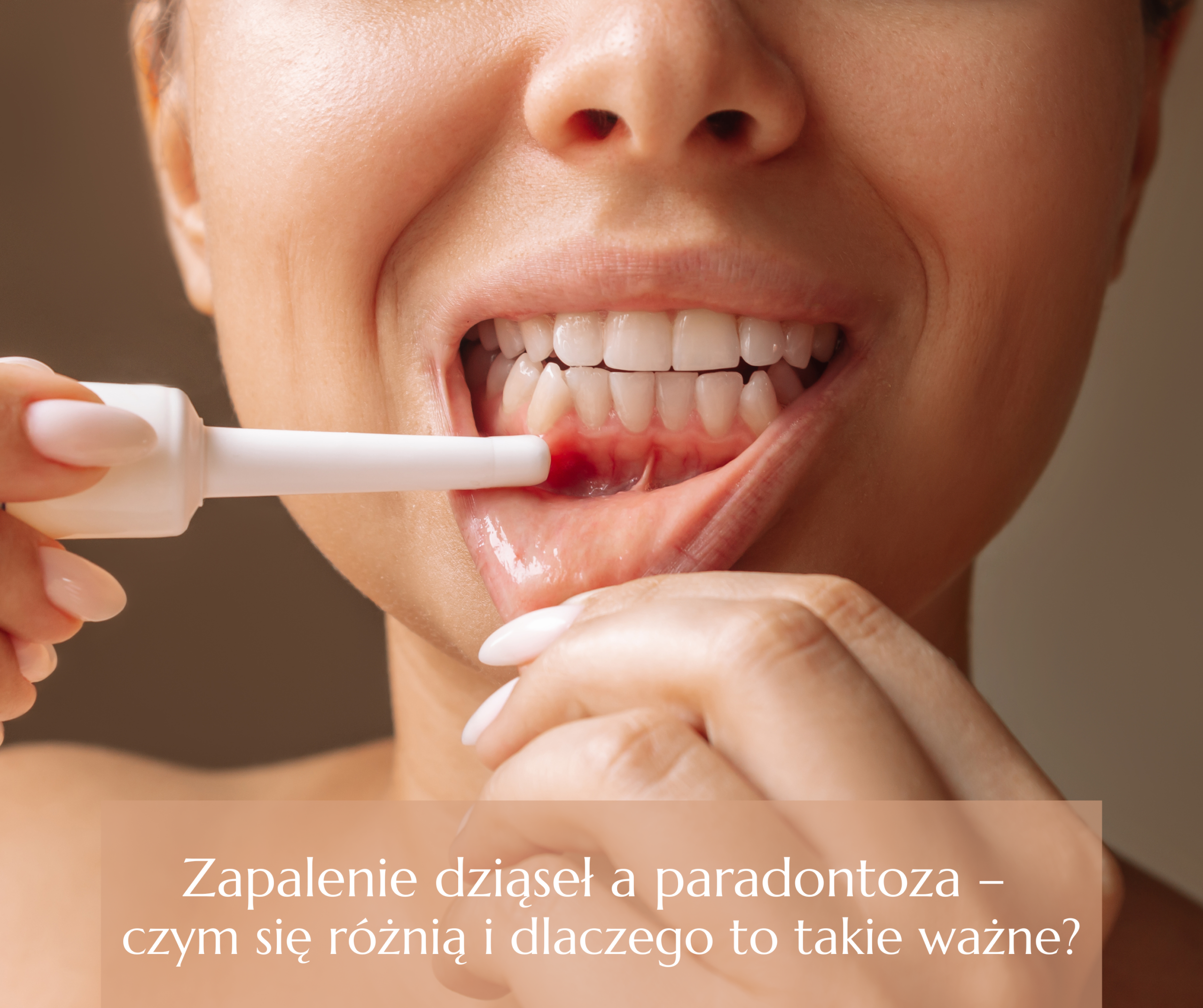 Zapalenie dziąseł a paradontoza
